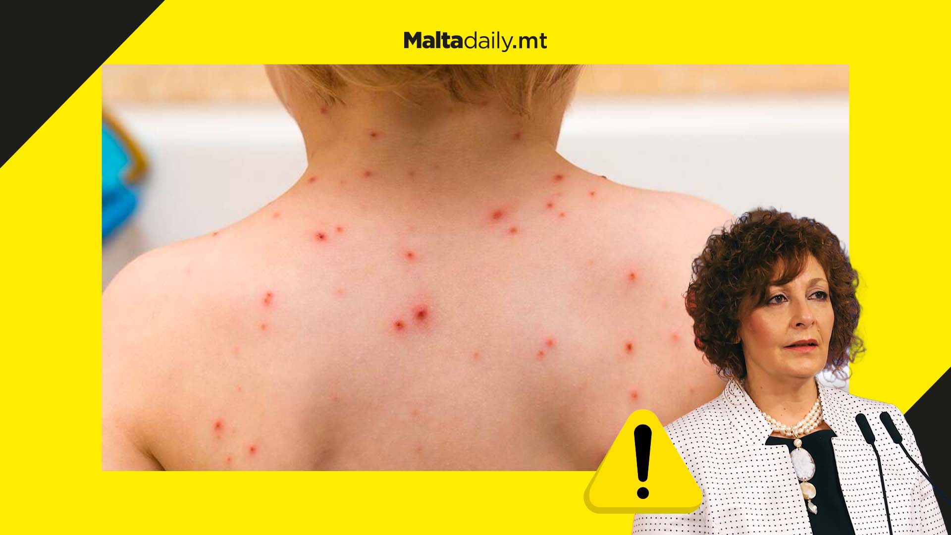 Three week isolation ordered for people with monkeypox